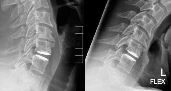 Cervical Surgery - Cervical Disk Replacement