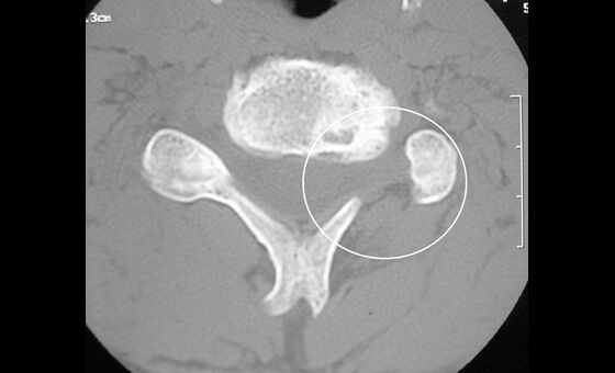 Cervical Surgery - Cervical Foraminotomy