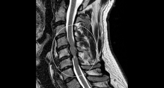 Cervical Surgery - Cervical Laminectomy