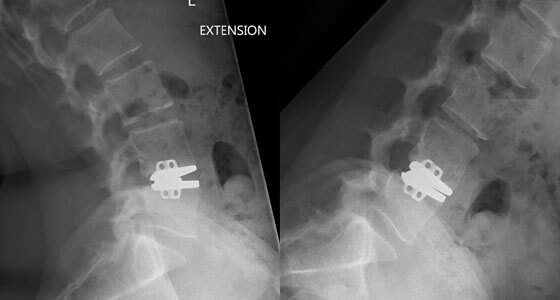 Lumbar Surgery - Lumbar Disc Replacement
