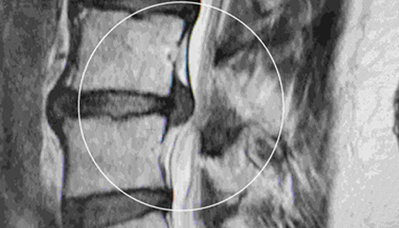 Lumbar Surgery - Lumbar Microdiscectomy