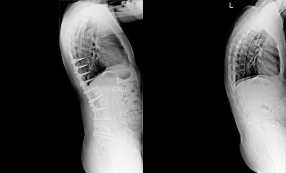 Spinal Deformity Surgery